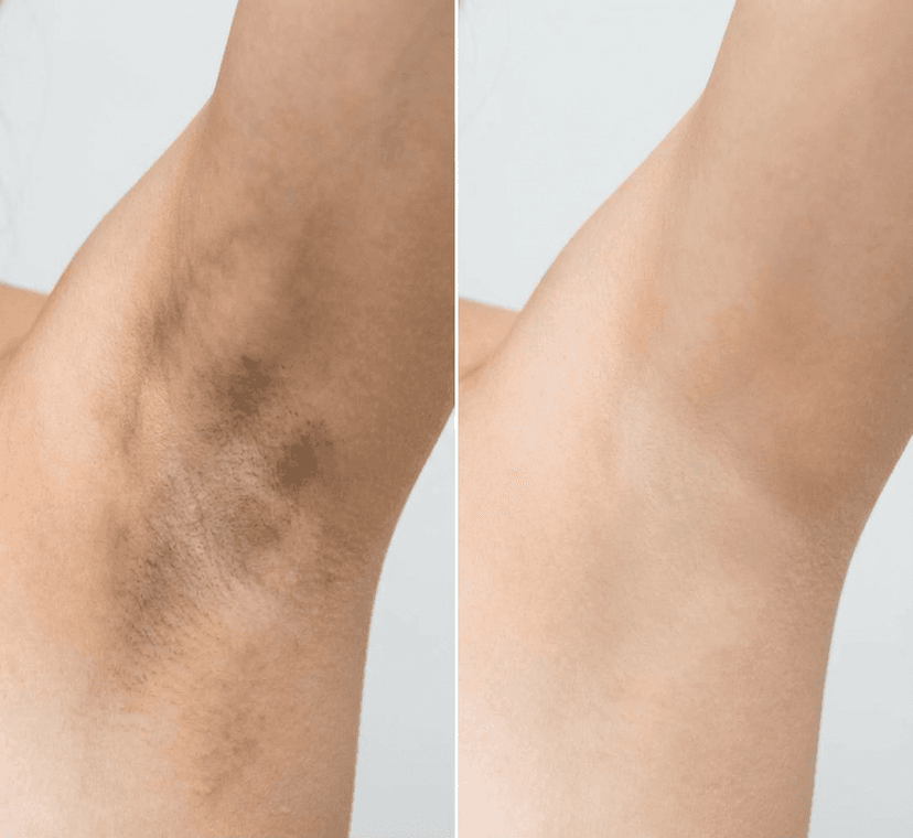 Antes e Depois Axilas